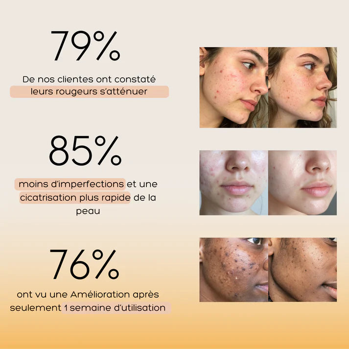 Baumes Apaisants Anti-Acné