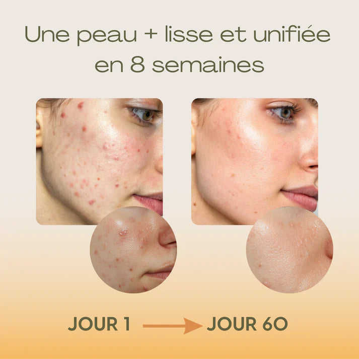 Baumes Apaisants Anti-Acné