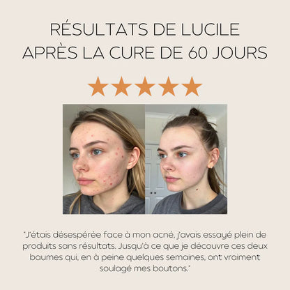 Baumes Apaisants Anti-Acné